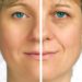 Os benefícios do botox no tratamento contra rugas de expressão